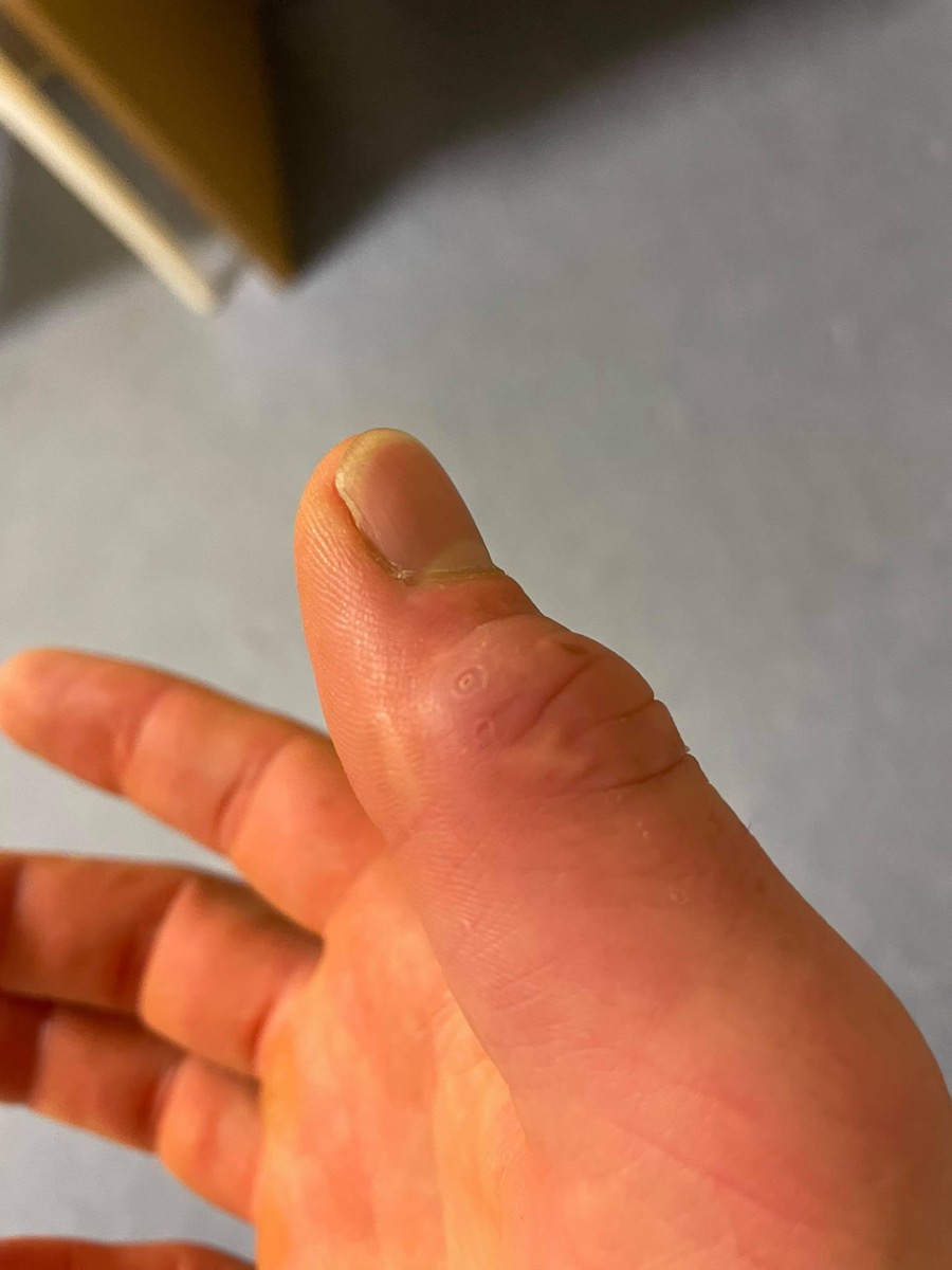 Healing scar from a kina spike injury on Alex's thumb