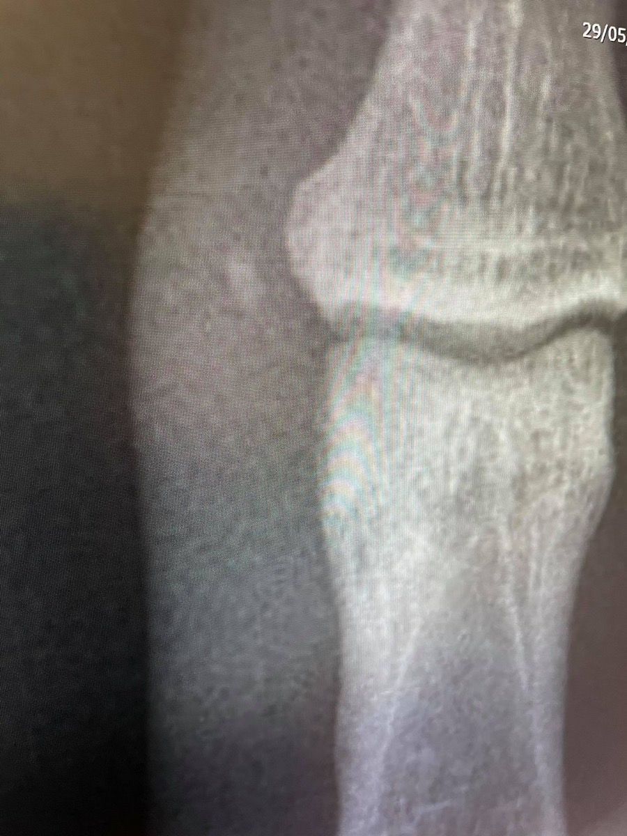 X-ray of Alex's thumb after a kina spike injury